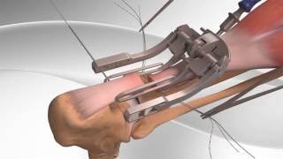 Achilles Tendon Rupture Repair with Arthrex PARS System