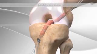 All-Inside ACL Reconstruction