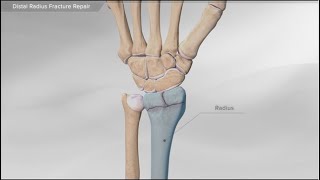 Distal Radius Fracture Repair