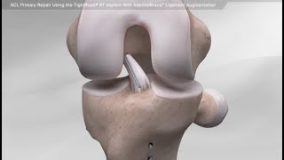 ACL Primary Repair