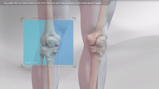 Adjustable Meniscal Root Marking Hook