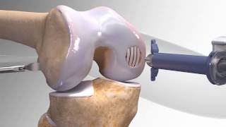 Cartilage Repair with Arthrex