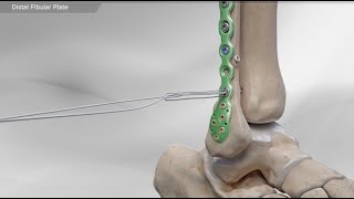 Distal Fibular Plate