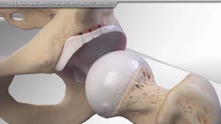 Hip Labral Repair With 2.4 mm Mini Hip PushLock Anchors