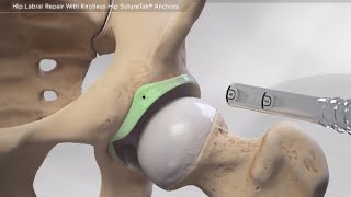 Hip Labral Repair With Knotless Hip SutureTak Anchors