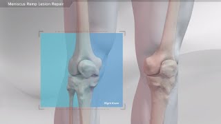 Meniscus Ramp Lesion Repair