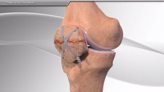 Patella Fracture Repair