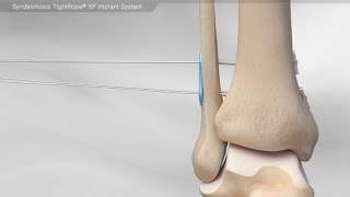 Syndesmosis TightRope XP Implant System