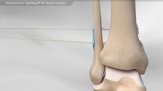 Syndesmosis TightRope XP Implant System