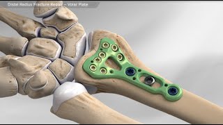 Distal Radius Fracture Repair - Volar Plate